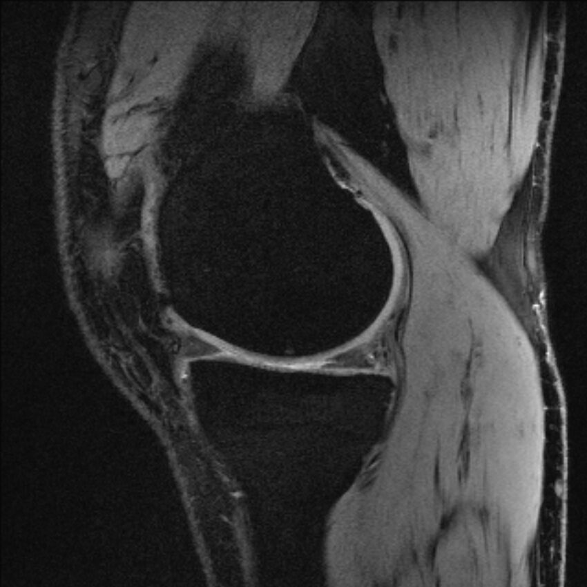 Anterior cruciate ligament mucoid degeneration (Radiopaedia 68400-77933 Sagittal 47).jpg