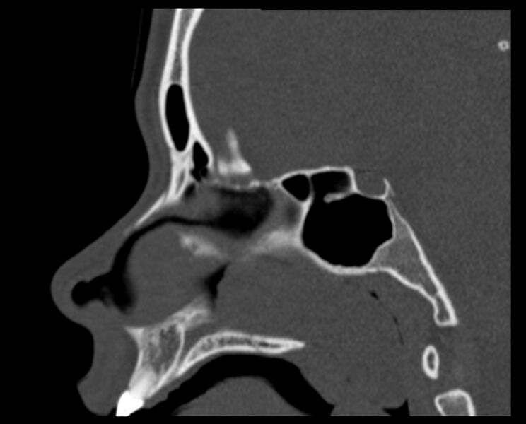 File:Antrochoanal polyp (Radiopaedia 21894-21868 Sagittal bone window 20).jpg