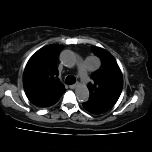 File:Aortic arch pseudoaneurysm (Radiopaedia 8534-9368 Axial non-contrast 26).jpg
