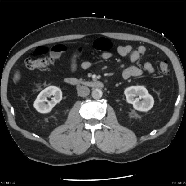 File:Aortic dissection- Stanford A (Radiopaedia 37759-39664 A 102).jpg