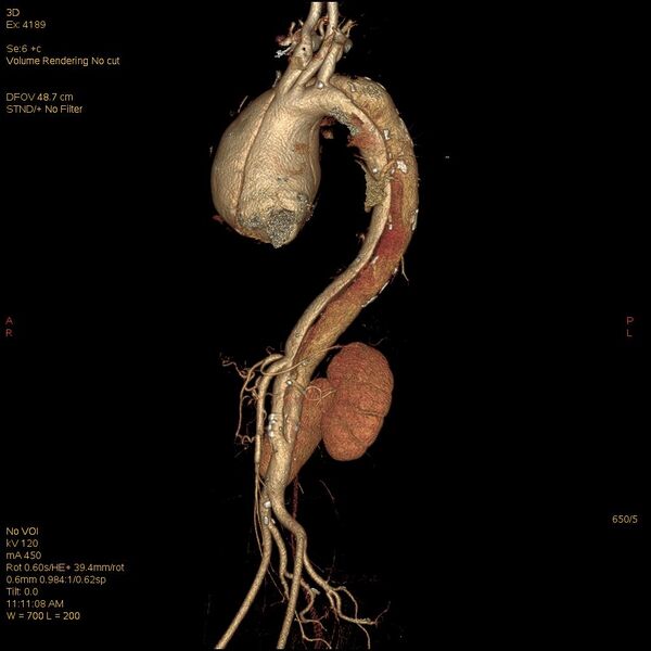 File:Aortic dissection (Radiopaedia 25350-25604 E 5).jpg