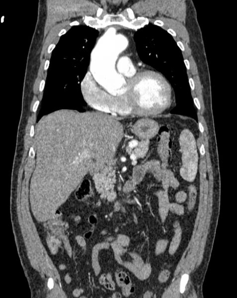 File:Aortic dissection (Radiopaedia 44411-48061 A 11).jpg