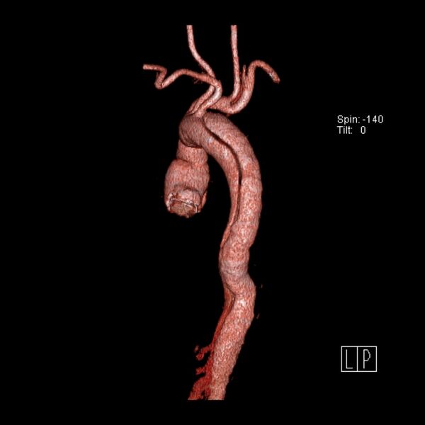 File:Aortic dissection - De Bakey type III - Stanford B (Radiopaedia 21903-21882 3D C+ arterial phase 12).jpg