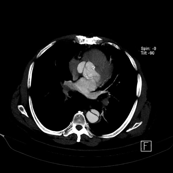 File:Aortic dissection - De Bakey type III - Stanford B (Radiopaedia 21903-21882 B 31).jpg