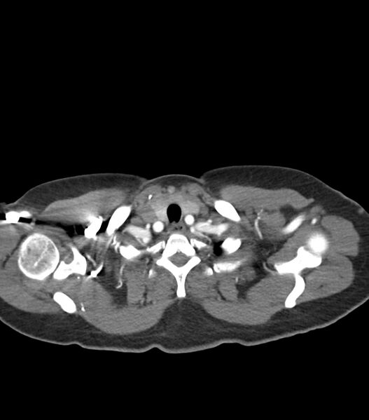 File:Aortic dissection with renal ischemia (Radiopaedia 76573-88338 A 1).jpg
