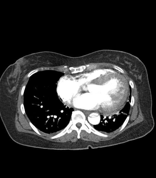 File:Aortic dissection with renal ischemia (Radiopaedia 76573-88338 A 46).jpg
