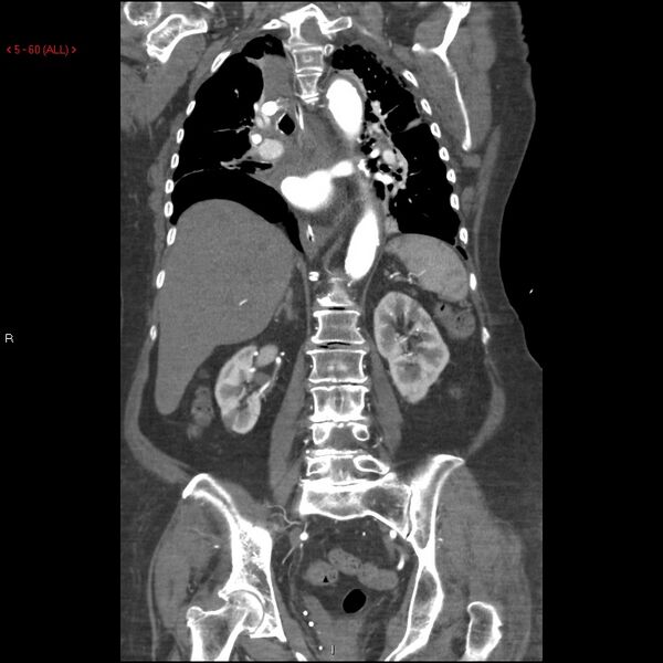 File:Aortic intramural hematoma (Radiopaedia 27746-28001 B 37).jpg