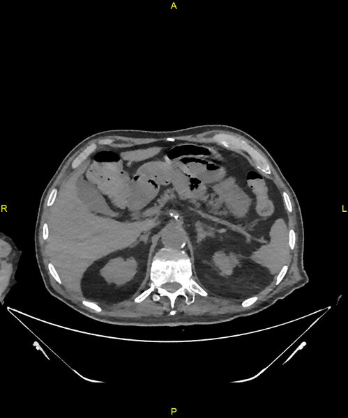 File:Aortoenteric fistula (Radiopaedia 84308-99603 Axial non-contrast 78).jpg