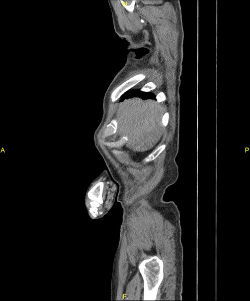 File:Aortoenteric fistula (Radiopaedia 84308-99603 C 27).jpg