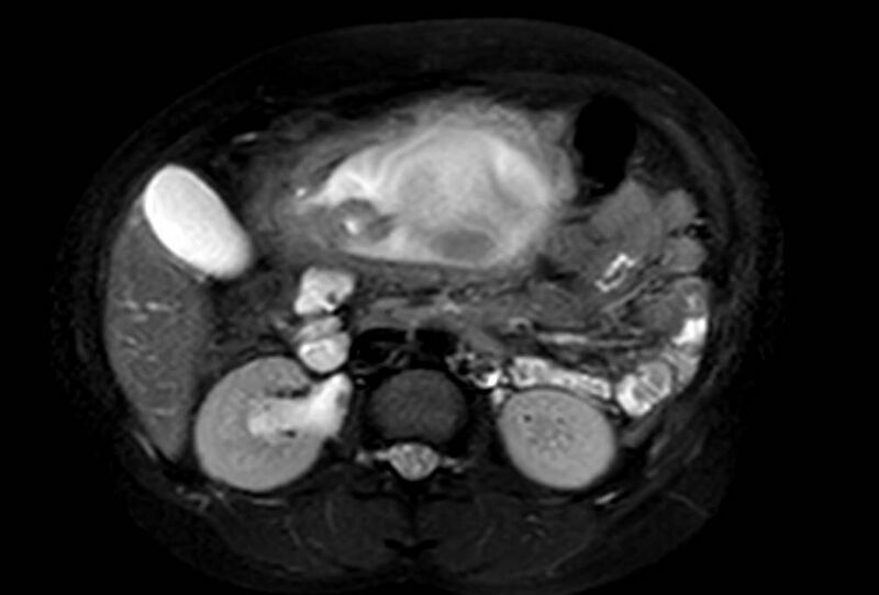File:Appendicitis in gravida (MRI) (Radiopaedia 89433-106395 Axial T2 SPAIR 31).jpg