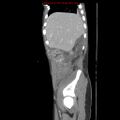 Appendicitis with phlegmon (Radiopaedia 9358-10046 F 6).jpg