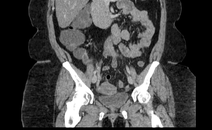 Appendix mucocele (Radiopaedia 41222-44033 B 39).jpg