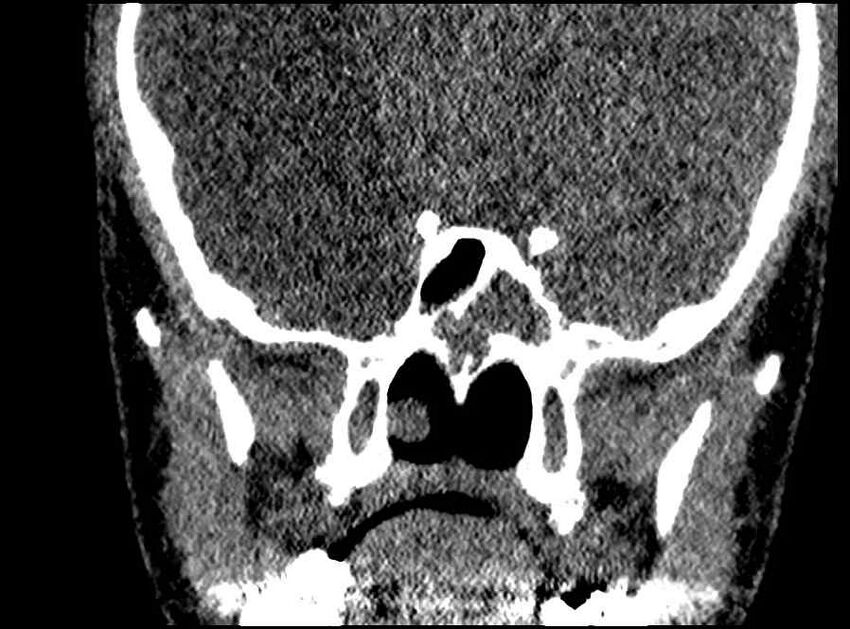 Arachnoid cyst- extremely large (Radiopaedia 68741-78450 Coronal bone window 22).jpg