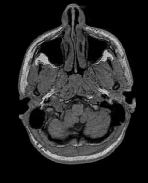 File:Arachnoid cyst- extremely large (Radiopaedia 68741-78451 Axial T1 11).jpg