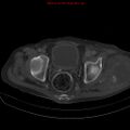 Arachnoiditis ossificans (Radiopaedia 51394-57136 Axial bone window 41).jpg