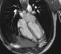 Arrhythmogenic right ventricular cardiomyopathy (Radiopaedia 39806-42237 D 78).jpg