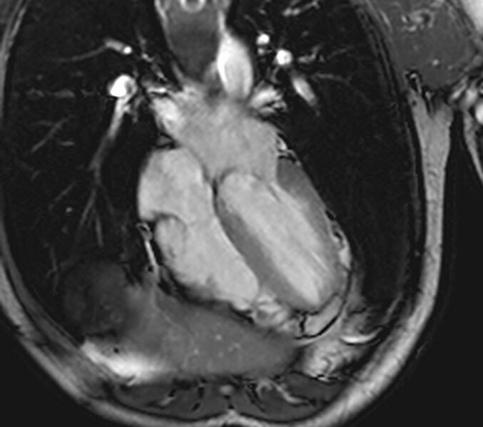 File:Arrhythmogenic right ventricular cardiomyopathy (Radiopaedia 39806-42237 D 78).jpg