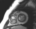 Arrhythmogenic right ventricular cardiomyopathy (Radiopaedia 69431-79307 Short axis cine 23).jpg