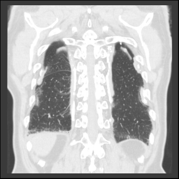 File:Asbestos-related pleural plaques (Radiopaedia 39069-41255 Coronal lung window 14).jpg