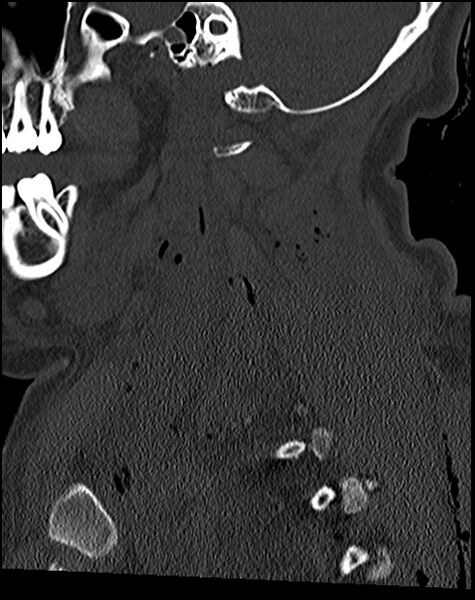File:Atlanto-occipital dissociation - Traynelis type 1 (Radiopaedia 87570-103948 Sagittal bone window 31).jpg