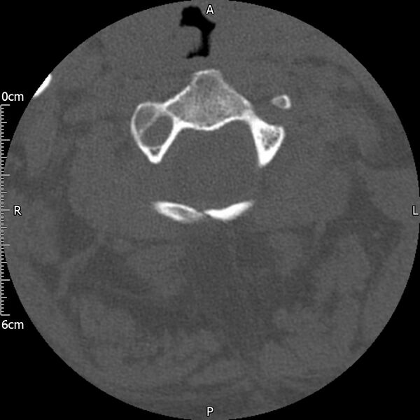 File:Atlas fracture with Currarino type A congenital defect (Radiopaedia 71747-82144 Axial bone window 57).jpg
