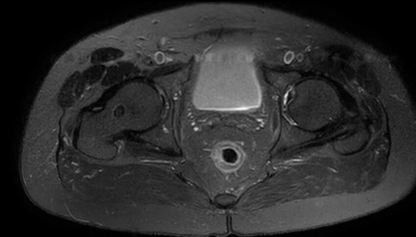 Atypical lipomatous tumor - thigh (Radiopaedia 68975-78734 Axial T2 fat sat 92).jpg