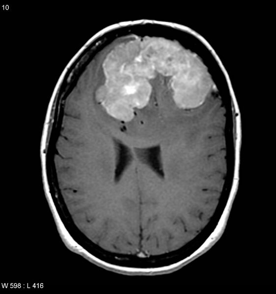File:Atypical meningioma (WHO grade II) (Radiopaedia 7762-8586 D 6).jpg