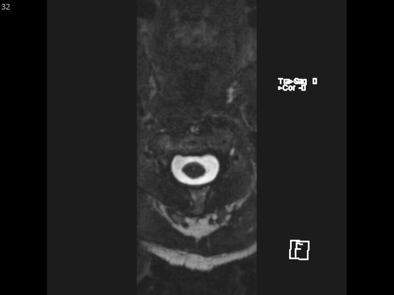 File:Atypical meningioma - intraosseous (Radiopaedia 64915-74572 Axial CISS 32).jpg