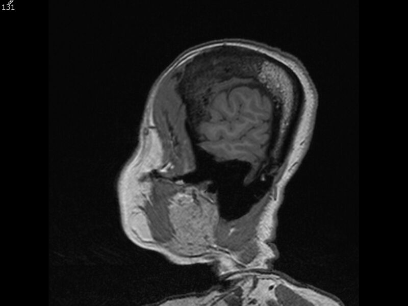 File:Atypical meningioma - intraosseous (Radiopaedia 64915-74572 Sagittal T1 131).jpg