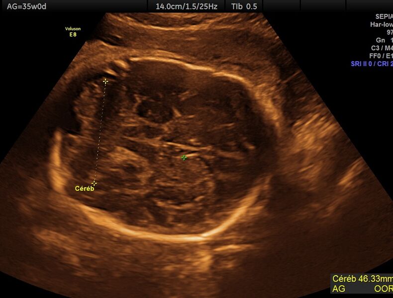 File:Atypical teratoid rhabdoid tumor (prenatal US and neonatal MRI) (Radiopaedia 59091-66386 C 1).jpg