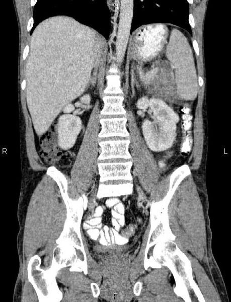 File:Autoimmune pancreatitis (Radiopaedia 84925-100431 D 37).jpg