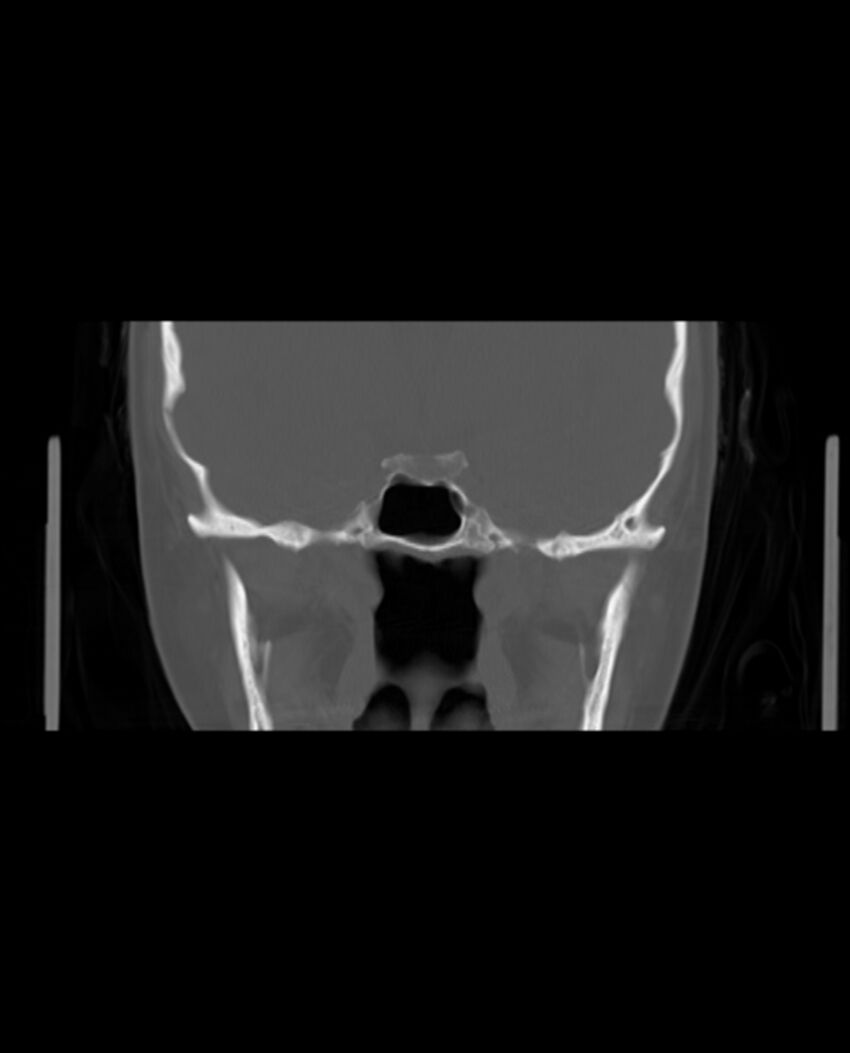 Automastoidectomy with labyrinthine fistula (Radiopaedia 84143-99411 Coronal non-contrast 74).jpg