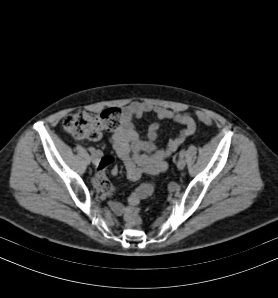 File:Autosomal dominant polycystic kidney disease (Radiopaedia 41918-44922 Axial non-contrast 29).jpg