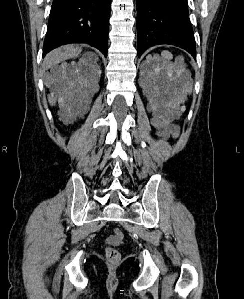 File:Autosomal dominant polycystic kidney disease (Radiopaedia 87830-104287 Coronal non-contrast 51).jpg