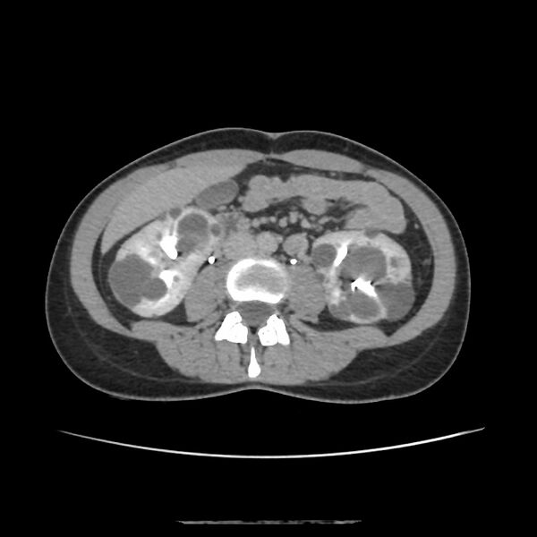 File:Autosomal dominant polycystic kidney disease - early onset (Radiopaedia 40734-43387 D 10).jpg