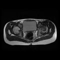Avascular necrosis of the hip (Radiopaedia 29563-30067 Axial T2 6).jpg