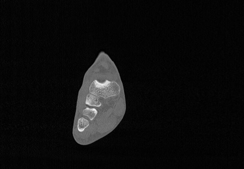 File:Avulsion fractures of talus and calcaneus (Radiopaedia 48277-53155 Coronal bone window 34).jpg