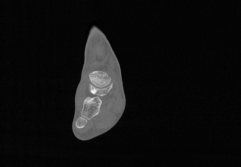 File:Avulsion fractures of talus and calcaneus (Radiopaedia 48277-53155 Coronal bone window 40).jpg