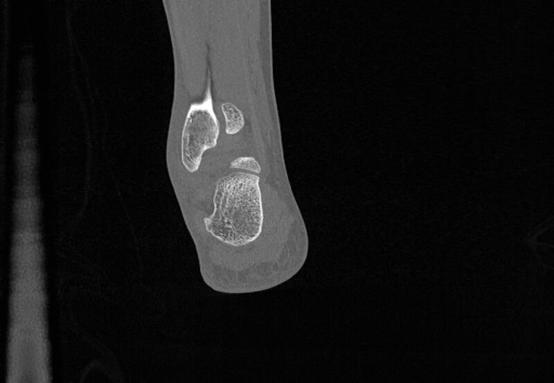File:Avulsion fractures of talus and calcaneus (Radiopaedia 48277-53155 Coronal bone window 84).jpg