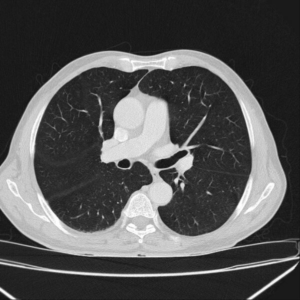 File:Azygos lobe (Radiopaedia 38259-40275 Axial lung window 38).jpg