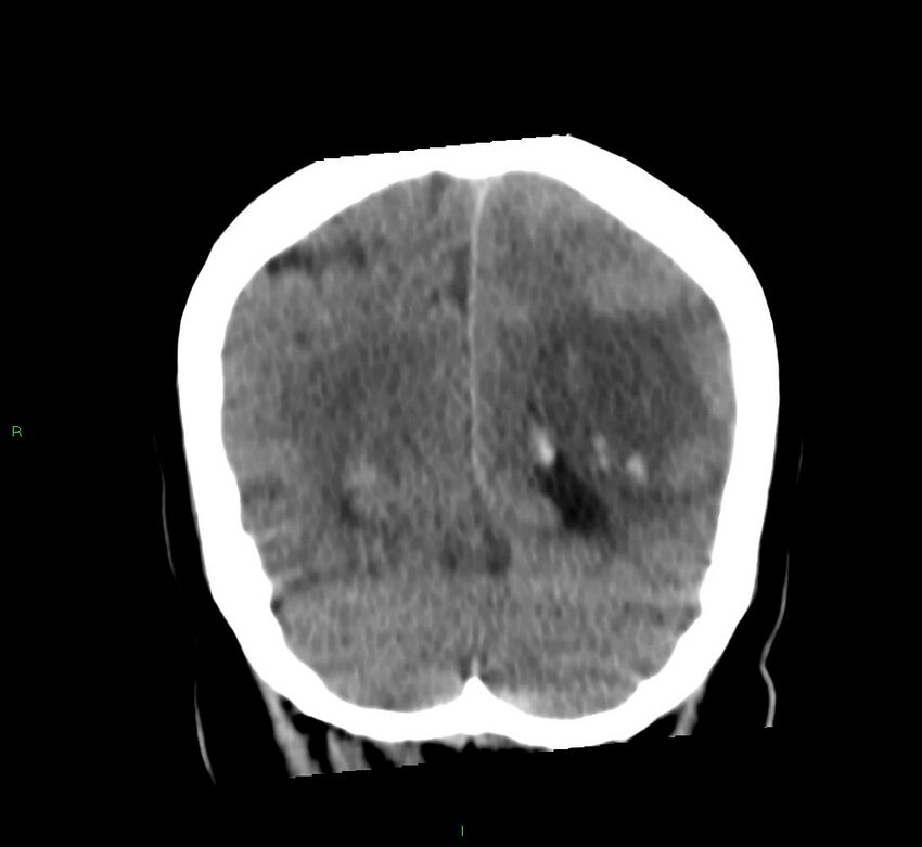 Basal ganglia hemorrhage (Radiopaedia 58759-65981 Coronal non-contrast 23).jpg