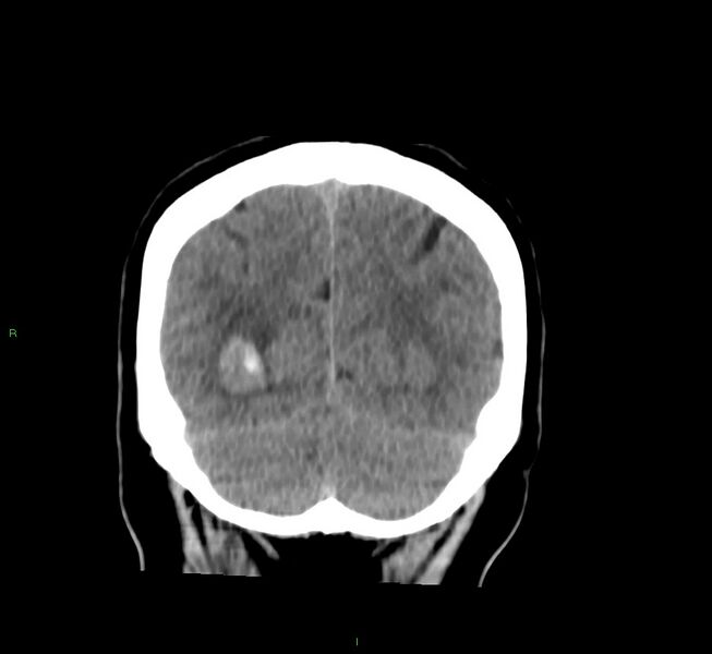 File:Basal ganglia hemorrhage (Radiopaedia 58763-65985 Coronal non-contrast 20).jpg