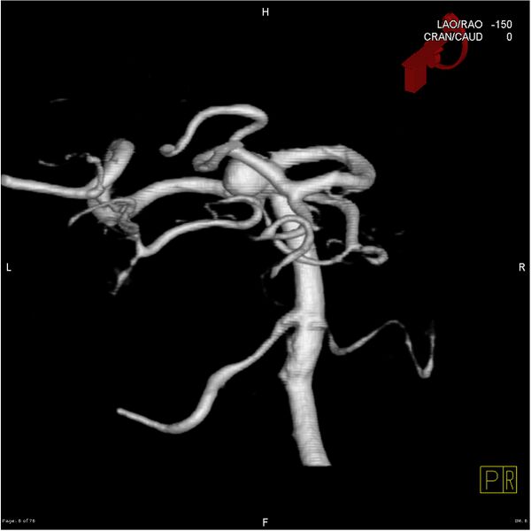File:Basilar tip aneurysm double balloon remodeling (Radiopaedia 18100-17883 3D rotation 6).jpg