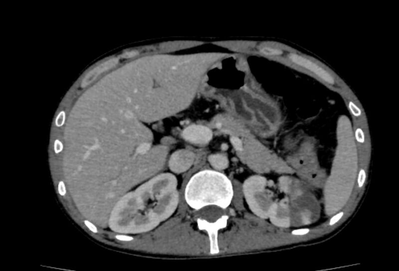 File:Behçet's disease- abdominal vasculitis (Radiopaedia 55955-62570 A 21).jpg