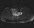 Bicornuate bicollis uterus (Radiopaedia 61626-69616 Axial PD fat sat 20).jpg