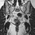 Bicornuate uterus (Radiopaedia 11104-11492 Coronal T2 23).jpg