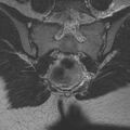 Bicornuate uterus (Radiopaedia 24677-24949 Coronal T2 22).jpg
