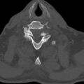 Bilateral C6-7 locked facet dislocation (Radiopaedia 28506-28748 Axial bone window 24).jpeg