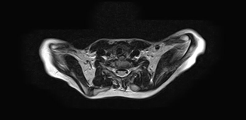 File:Bilateral Sprengel deformity with Klippel-Feil syndrome (Radiopaedia 66395-75650 Axial T2 17).jpg