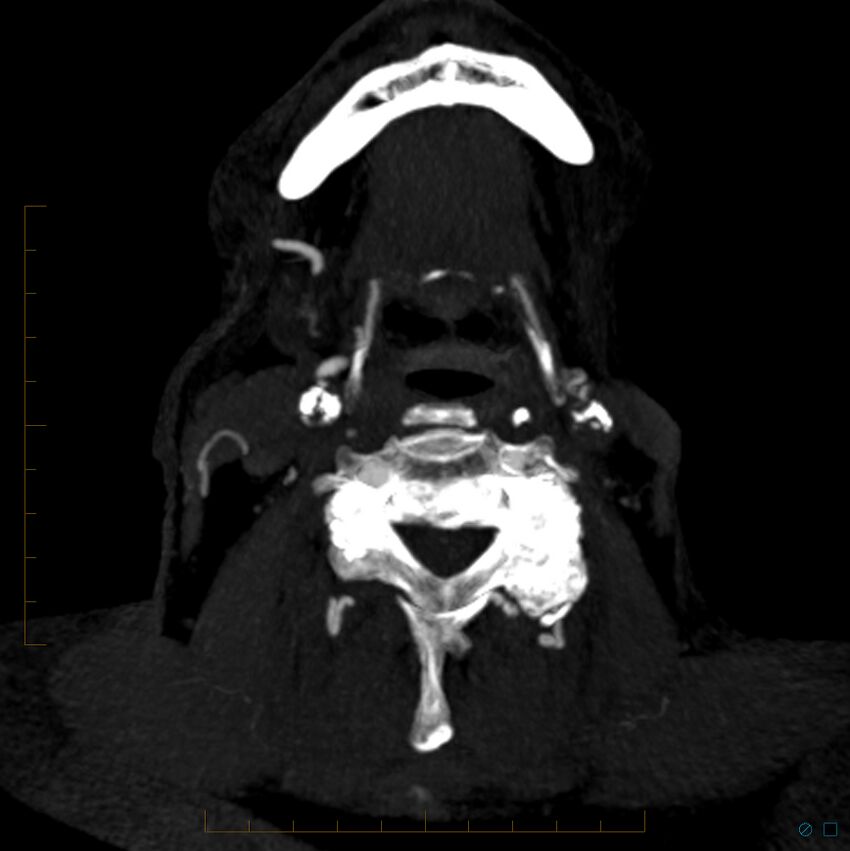 Bilateral chronic common carotid occlusion (Radiopaedia 50849-56362 D 40).jpg